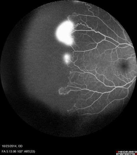 Sickle Retinopathy - Ultra Wide Field Angiogram - Heidelberg
Leakage from peripheral fronds of NV - HGB SC disease - 28 year old man with vision loss OS from acute vitreous hemorrhage
