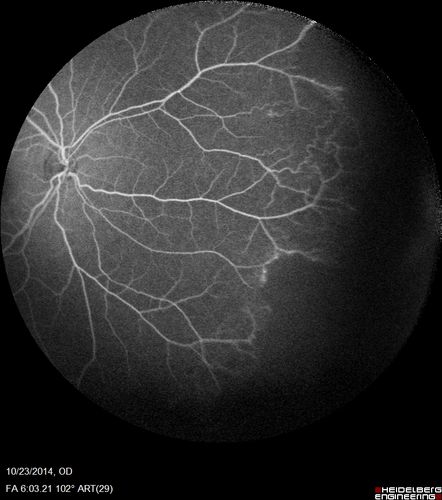 Sickle Retinopathy - Ultra Wide Field Angiogram - Heidelberg
Leakage from peripheral fronds of NV - HGB SC disease - 28 year old man with vision loss OS from acute vitreous hemorrhage
