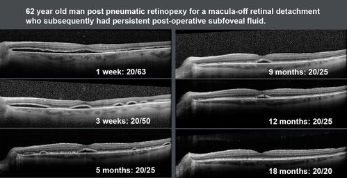 Persistent subfoveal fluid following retinal detachment repair
62 year old man following pneumatic retinopexy for macula-off retinal detachment.  Subfoveal fluid persisted for more than a year.
