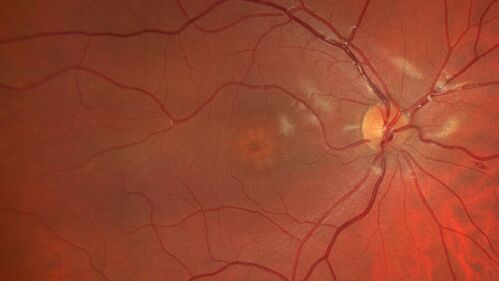 25 year old with Stargard and 2 ABCA4 mutations.
She has worn glasses since she was a kid.  Since she became an adult her vision started to deteriorate more rapidly.  This seems to have been happening since she entered the accounting department for the last two years.  Her vision is worse in the light especially when she is driving.  She can see green lights in the night but not in the day.  She sees better on a dark background than on a light background.  Her mom is genetically visually impaired with Stargardts.  Her father has RP.  The mother was genetically tested in Boston about 23 years ago.  That was when the gene was first being isolated. (The mother has seven brothers and sisters and four have stargardts and they are legally blind.  Also one cousin has it.)
VA OD: Dcc20/160-1 PH20/80 Ncc20/200-2
VA OS: Dcc20/160-2 PH20/80-1 Ncc20/200-1
IOP: TP: OD:20 OS:21
