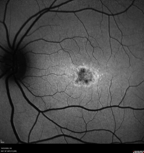 25 year old with Stargard and 2 ABCA4 mutations.
She has worn glasses since she was a kid.  Since she became an adult her vision started to deteriorate more rapidly.  This seems to have been happening since she entered the accounting department for the last two years.  Her vision is worse in the light especially when she is driving.  She can see green lights in the night but not in the day.  She sees better on a dark background than on a light background.  Her mom is genetically visually impaired with Stargardts.  Her father has RP.  The mother was genetically tested in Boston about 23 years ago.  That was when the gene was first being isolated. (The mother has seven brothers and sisters and four have stargardts and they are legally blind.  Also one cousin has it.)
VA OD: Dcc20/160-1 PH20/80 Ncc20/200-2
VA OS: Dcc20/160-2 PH20/80-1 Ncc20/200-1
IOP: TP: OD:20 OS:21
