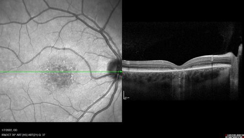 25 year old with Stargard and 2 ABCA4 mutations.
She has worn glasses since she was a kid.  Since she became an adult her vision started to deteriorate more rapidly.  This seems to have been happening since she entered the accounting department for the last two years.  Her vision is worse in the light especially when she is driving.  She can see green lights in the night but not in the day.  She sees better on a dark background than on a light background.  Her mom is genetically visually impaired with Stargardts.  Her father has RP.  The mother was genetically tested in Boston about 23 years ago.  That was when the gene was first being isolated. (The mother has seven brothers and sisters and four have stargardts and they are legally blind.  Also one cousin has it.)
VA OD: Dcc20/160-1 PH20/80 Ncc20/200-2
VA OS: Dcc20/160-2 PH20/80-1 Ncc20/200-1
IOP: TP: OD:20 OS:21
