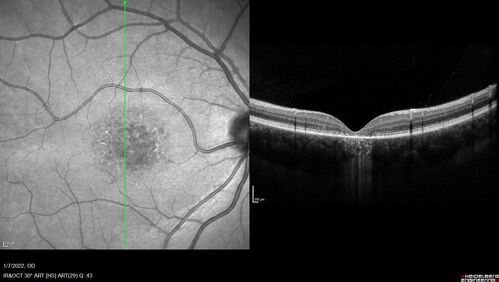 25 year old with Stargard and 2 ABCA4 mutations.
She has worn glasses since she was a kid.  Since she became an adult her vision started to deteriorate more rapidly.  This seems to have been happening since she entered the accounting department for the last two years.  Her vision is worse in the light especially when she is driving.  She can see green lights in the night but not in the day.  She sees better on a dark background than on a light background.  Her mom is genetically visually impaired with Stargardts.  Her father has RP.  The mother was genetically tested in Boston about 23 years ago.  That was when the gene was first being isolated. (The mother has seven brothers and sisters and four have stargardts and they are legally blind.  Also one cousin has it.)
VA OD: Dcc20/160-1 PH20/80 Ncc20/200-2
VA OS: Dcc20/160-2 PH20/80-1 Ncc20/200-1
IOP: TP: OD:20 OS:21
