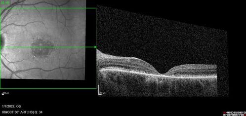25 year old with Stargard and 2 ABCA4 mutations.
She has worn glasses since she was a kid.  Since she became an adult her vision started to deteriorate more rapidly.  This seems to have been happening since she entered the accounting department for the last two years.  Her vision is worse in the light especially when she is driving.  She can see green lights in the night but not in the day.  She sees better on a dark background than on a light background.  Her mom is genetically visually impaired with Stargardts.  Her father has RP.  The mother was genetically tested in Boston about 23 years ago.  That was when the gene was first being isolated. (The mother has seven brothers and sisters and four have stargardts and they are legally blind.  Also one cousin has it.)
VA OD: Dcc20/160-1 PH20/80 Ncc20/200-2
VA OS: Dcc20/160-2 PH20/80-1 Ncc20/200-1
IOP: TP: OD:20 OS:21
