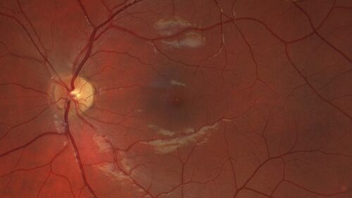 Stargardt Disease - Very Mild - 24 year old
This patient has 3 different ABCA4 mutations.  His mother and sister have stargardts and his father has RP.  His sisters images are also on Retinagallery.com
