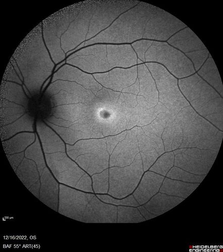 Stargardt Disease - Very Mild - 24 year old
This patient has 3 different ABCA4 mutations.  His mother and sister have stargardts and his father has RP.  His sisters images are also on Retinagallery.com

