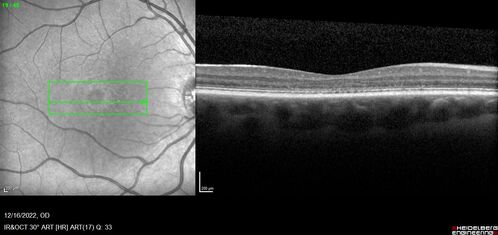 Stargardt Disease - Very Mild - 24 year old
This patient has 3 different ABCA4 mutations.  His mother and sister have stargardts and his father has RP.  His sisters images are also on Retinagallery.com
