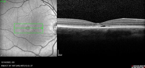 Stargardt Disease - Very Mild - 24 year old
This patient has 3 different ABCA4 mutations.  His mother and sister have stargardts and his father has RP.  His sisters images are also on Retinagallery.com
