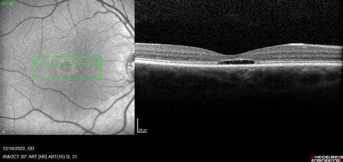 Stargardt Disease - Very Mild - 24 year old
This patient has 3 different ABCA4 mutations.  His mother and sister have stargardts and his father has RP.  His sisters images are also on Retinagallery.com
