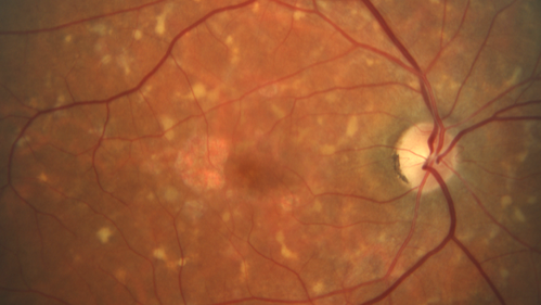 Stargardt's Macular Dystrophy
62 year old man with good vision
