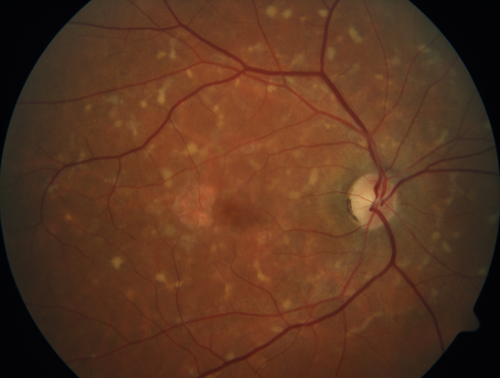 Stargardt's Macular Dystrophy
62 year old man with good vision
