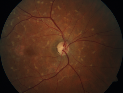 Stargardt's Macular Dystrophy
62 year old man with good vision
