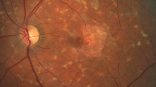 Stargardt's Macular Dystrophy
62 year old man with good vision
