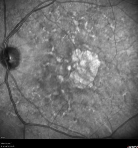 Stargardt's Macular Dystrophy
62 year old man with good vision
