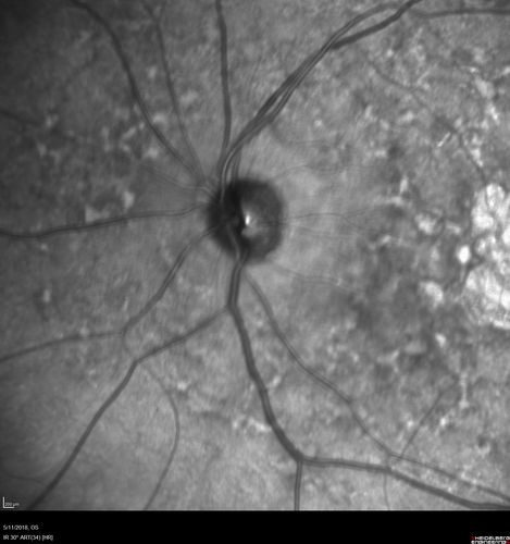 Stargardt's Macular Dystrophy
62 year old man with good vision
