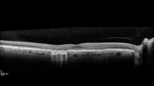 Stargardt's Macular Dystrophy
62 year old man with good vision
