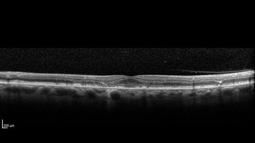 Stargardt's Macular Dystrophy
62 year old man with good vision
