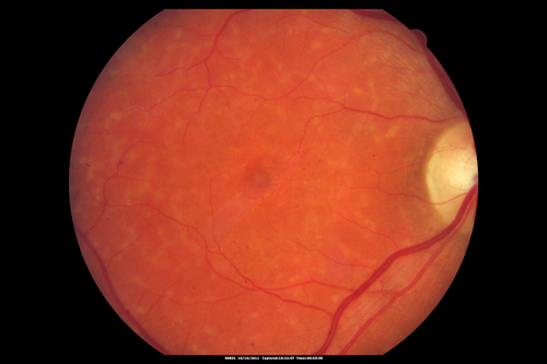Stargardt's Macular Dystrophy ABCA4 positive
Images show some progression over 3 years of macular dystrophy.
