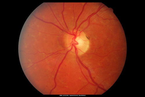 Stargardt's Macular Dystrophy ABCA4 positive
Images show some progression over 3 years of macular dystrophy.
