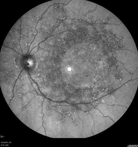 Stargardt's Macular Dystrophy ABCA4 positive
Images show some progression over 3 years of macular dystrophy.

