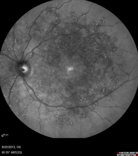 Stargardt's Macular Dystrophy ABCA4 positive
Images show some progression over 3 years of macular dystrophy.
