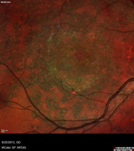 Stargardt's Macular Dystrophy ABCA4 positive
Images show some progression over 3 years of macular dystrophy.

