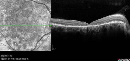 Stargardt's Macular Dystrophy ABCA4 positive
Images show some progression over 3 years of macular dystrophy.
