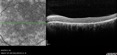 Stargardt's Macular Dystrophy ABCA4 positive
Images show some progression over 3 years of macular dystrophy.
