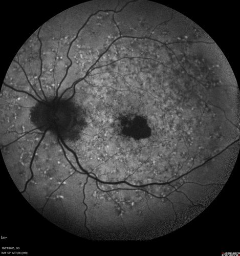 Stargardt's Macular Dystrophy ABCA4 positive
 Fundus Autofluorescence shows central atrophy with Hyper FAF pisciform triradiate lesions. Images show some progression over 3 years of macular dystrophy.
