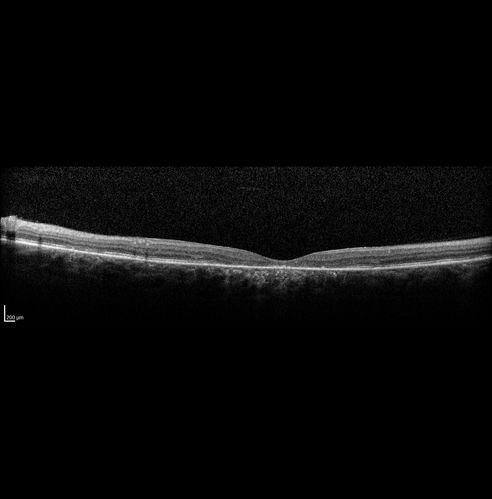 Stargardt's Macular Dystrophy ABCA4 positive
Images show some progression over 3 years of macular dystrophy.

