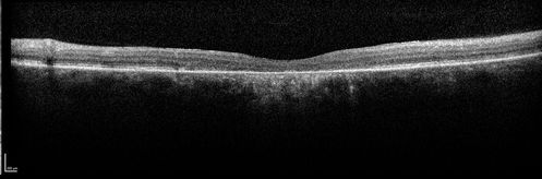 Stargardt's Macular Dystrophy ABCA4 positive
Images show some progression over 3 years of macular dystrophy.
