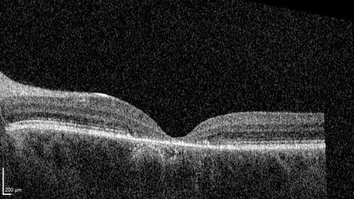 Stargardt - Mother with Stargadts and father with RP
Her mom is genetically visually impaired with Stargardts.  Her father has RP.  The mother was genetically tested in Boston about 23 years ago.  That was when the gene was first being isolated. (The mother has seven brothers and sisters and four have stargardts and they are legally blind.  Also one cousin has it.)

VA OD: 20/160 OS: 20/160

She tested positive for ABCA4
