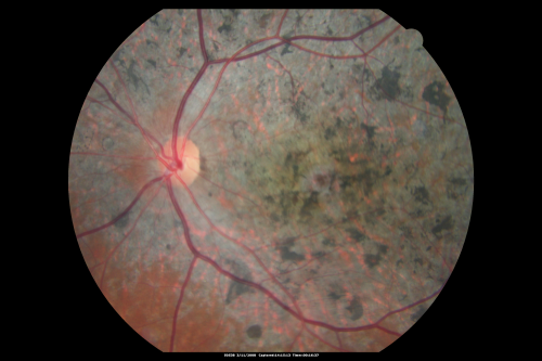 Stargart's Macular Dystrophy - Severe
32-year-old man carries a diagnosis of Stargardtâ€™s disease with poor vision in both eyes since he was 13. He has not noticed any substantial change since he was here 4 years ago.
VISUAL ACUITY: OD 10/200, OS 8/200
Keywords: stargart' stargart