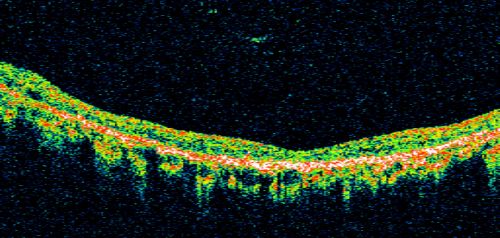 Stargart's Macular Dystrophy Severe
32-year-old man carries a diagnosis of Stargardtâ€™s disease with poor vision in both eyes since he was 13. He has not noticed any substantial change since he was here 4 years ago.
VISUAL ACUITY: OD 10/200, OS 8/200
Keywords: stargart' stargart