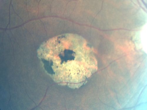 Stargardt's Disease - Macular Dystrophy - 69 Year Old African American Male - 20/200 both eyes
69-year-old man has had vision loss in both eyes starting 20 years ago. He was diagnosed at one point with Stargardtâ€™s macular dystrophy.  When I saw him, he had retinal atrophy in each eye. 
Vision is 20/200 in each eye
