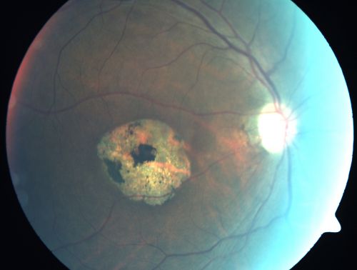Stargardt's Disease - Macular Dystrophy - 69 Year Old African American Male - 20/200 both eyes
69-year-old man has had vision loss in both eyes starting 20 years ago. He was diagnosed at one point with Stargardtâ€™s macular dystrophy.  When I saw him, he had retinal atrophy in each eye. 
Vision is 20/200 in each eye
