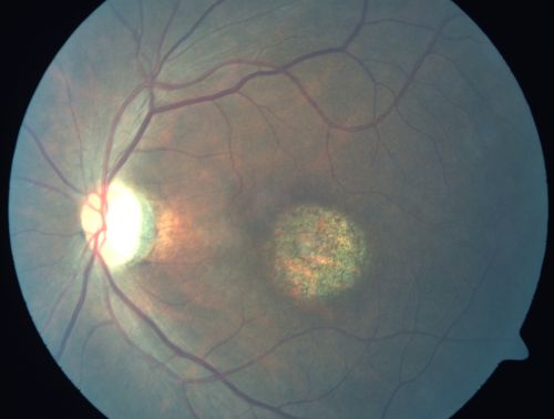 Stargardt's Disease - Macular Dystrophy - 69 Year Old African American Male - 20/200 both eyes
69-year-old man has had vision loss in both eyes starting 20 years ago. He was diagnosed at one point with Stargardtâ€™s macular dystrophy.  When I saw him, he had retinal atrophy in each eye. 
Vision is 20/200 in each eye
