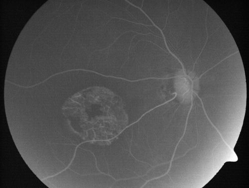 Stargardt's Disease - Macular Dystrophy - 69 Year Old African American Male - 20/200 both eyes
69-year-old man has had vision loss in both eyes starting 20 years ago. He was diagnosed at one point with Stargardtâ€™s macular dystrophy.  When I saw him, he had retinal atrophy in each eye. 
Vision is 20/200 in each eye
