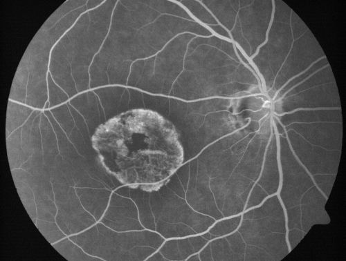 Stargardt's Disease - Macular Dystrophy - 69 Year Old African American Male - 20/200 both eyes
69-year-old man has had vision loss in both eyes starting 20 years ago. He was diagnosed at one point with Stargardtâ€™s macular dystrophy.  When I saw him, he had retinal atrophy in each eye. 
Vision is 20/200 in each eye
