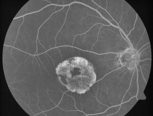 Stargardt's Disease - Macular Dystrophy - 69 Year Old African American Male - 20/200 both eyes
69-year-old man has had vision loss in both eyes starting 20 years ago. He was diagnosed at one point with Stargardtâ€™s macular dystrophy.  When I saw him, he had retinal atrophy in each eye. 
Vision is 20/200 in each eye
