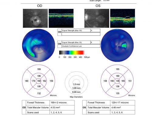 Stargardt's Disease - Macular Dystrophy - 69 Year Old African American Male - 20/200 both eyes
69-year-old man has had vision loss in both eyes starting 20 years ago. He was diagnosed at one point with Stargardtâ€™s macular dystrophy.  When I saw him, he had retinal atrophy in each eye. 
Vision is 20/200 in each eye
