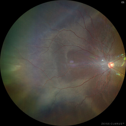 Sticklers syndrome with Pierre Robin Sequence
9 year old child with father who had retinal detachment at age 10.  History of cleft palate repair and teeth removal.  VA 20/40 OU.  Images show perivascular RPE and retinal changes especially nasally
