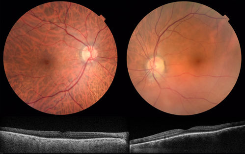 Sturge-Weber with Choroidal Hemangioma Left Eye
VA 20/25 OU.  Left eye treated for glaucoma with drops.
