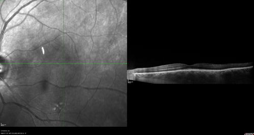 Sturge Weber SD OCT EDI showing choroidal thickening
