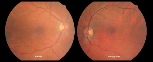 Sturge-Weber Encephalotigeminal Angiomatosis - Facial Hemangioma and Asymptomatic Ipsilateral Diffuse Choroidal Hemangioma
61-year-old man with Sturge-Weber syndrome with a hemangioma on the left side of his face. 

VISUAL ACUITY:  Vision OD is 20/50, PH 20/30; OS 20/80, PH 20/30.  IOP:  OD 16, OS 19.

