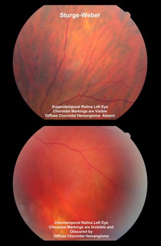 Sturge-Weber Encephalotigeminal Angiomatosis - Facial Hemangioma and Asymptomatic Ipsilateral Diffuse Choroidal Hemangioma
61-year-old man with Sturge-Weber syndrome with a hemangioma on the left side of his face. 

VISUAL ACUITY:  Vision OD is 20/50, PH 20/30; OS 20/80, PH 20/30.  IOP:  OD 16, OS 19.

