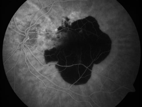 Wet AMD Fresh Submacular Hemorrhage - Displaced with Vitrectomy and Subretinal TPA
85-year-old woman has wet age-related macular degeneration in her better eye and she was reading with it until two days ago when she had sudden severe vision loss in the eye.  Her last injection with Avastin 2 weeks ago   20/160 (Pre-Surgical Displacement)
Keywords: submacular hemorrhage;tpa displacement;wet amd; 