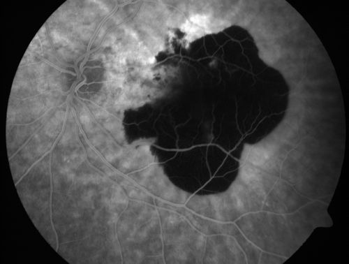 Wet AMD Fresh Submacular Hemorrhage - Displaced with Vitrectomy and Subretinal TPA
85-year-old woman has wet age-related macular degeneration in her better eye and she was reading with it until two days ago when she had sudden severe vision loss in the eye.  Her last injection with Avastin 2 weeks ago   20/160 (Pre-Surgical Displacement)
Keywords: submacular hemorrhage;tpa displacement;wet amd; 