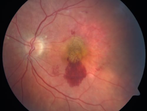 Wet AMD Fresh Submacular Hemorrhage - Displaced with Vitrectomy and Subretinal TPA
85-year-old woman has wet age-related macular degeneration in her better eye and she was reading with it until two days ago when she had sudden severe vision loss in the eye.  Post-surgical displacment vision was 20/120.
Keywords: submacular hemorrhage;tpa displacement;wet amd; 