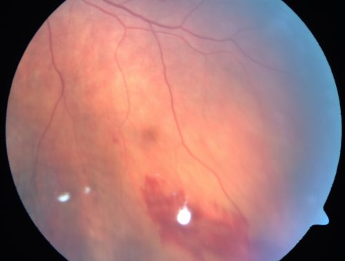 Wet AMD Fresh Submacular Hemorrhage - Displaced with Vitrectomy and Subretinal TPA
85-year-old woman has wet age-related macular degeneration in her better eye and she was reading with it until two days ago when she had sudden severe vision loss in the eye.  Post-surgical displacment vision was 20/120.
Keywords: submacular hemorrhage;tpa displacement;wet amd; 
